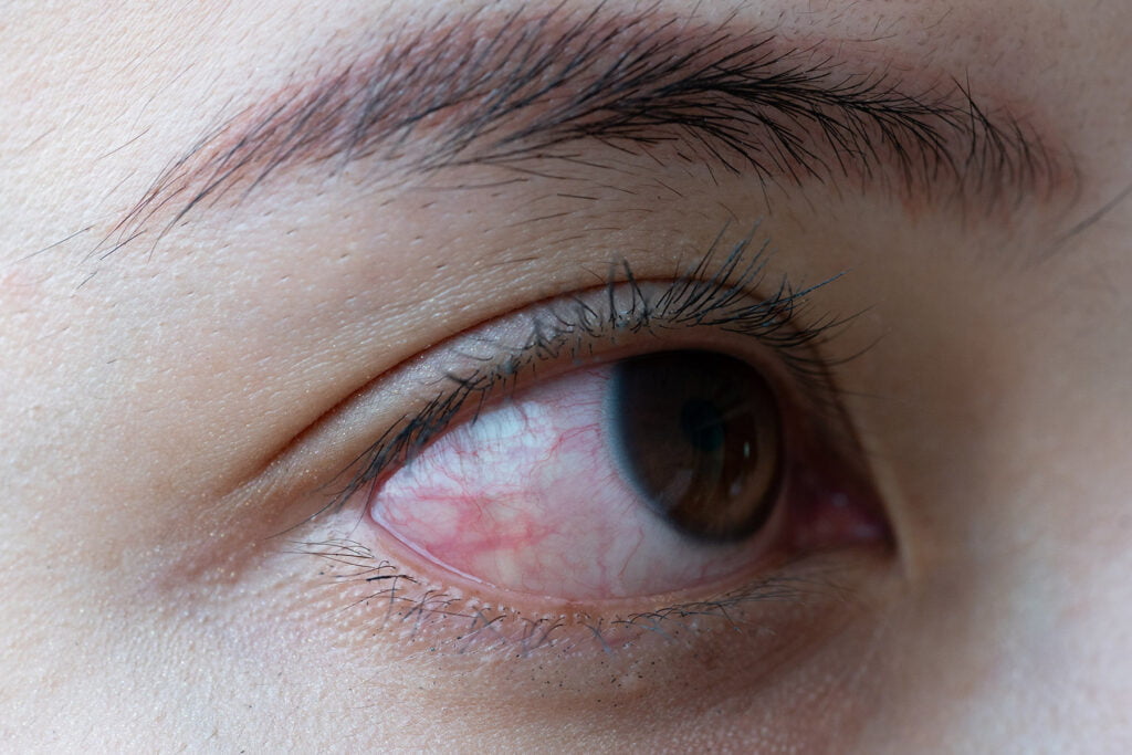 Close up of a severe bloodshot eye