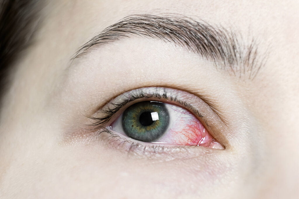 Close up of woman with red bloodshot eye